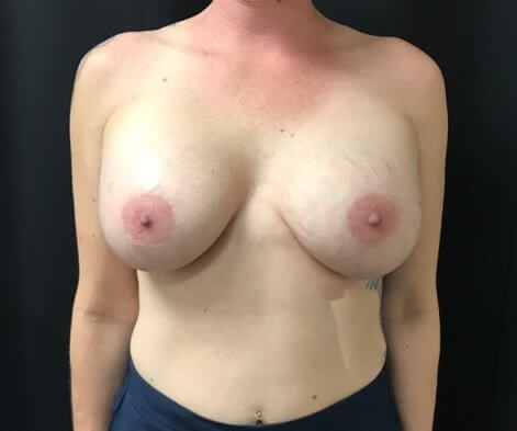 Silicone Breast Augmentation After