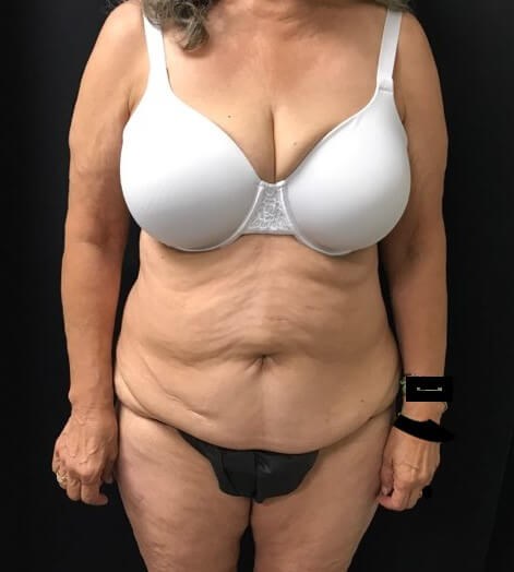 ABDOMINOPLASTY & LIPO OF SIDES Before