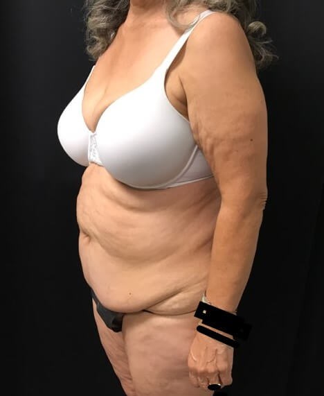 Left side view Before