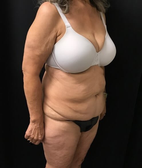 Right side view Before