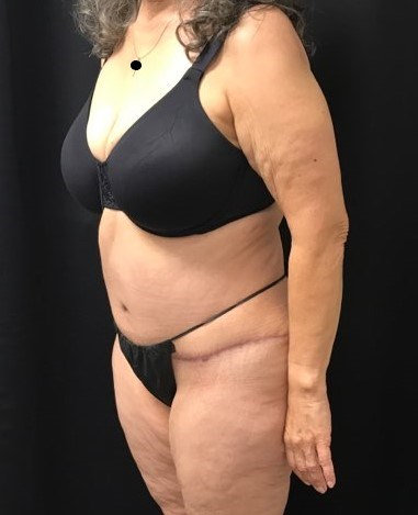 Left side view After