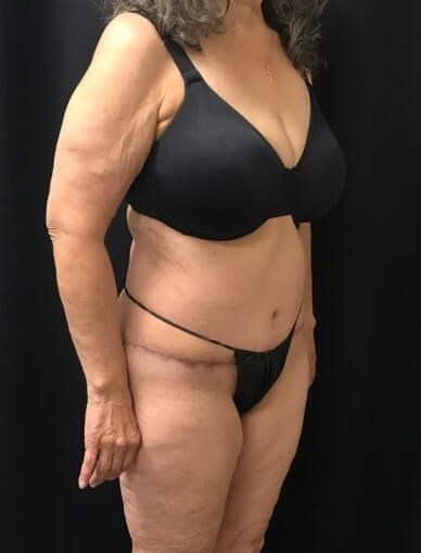 Right side view After