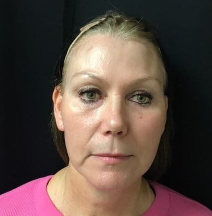 FACE/NECK BROW LIFT, LOWER LID After