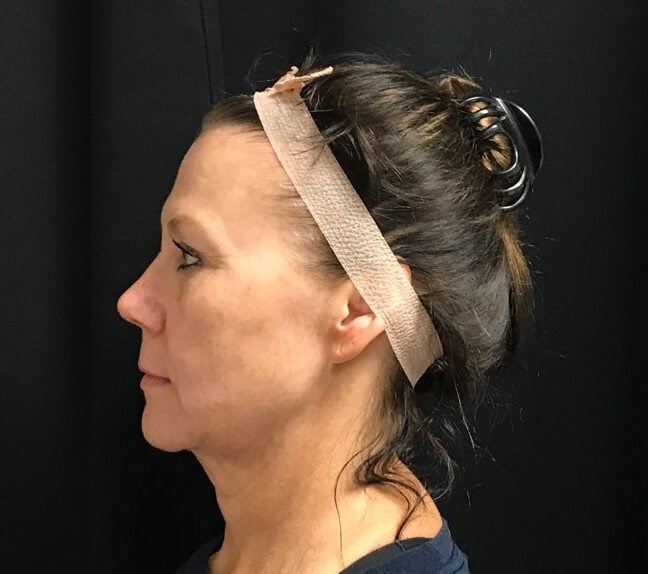 Left side view Before