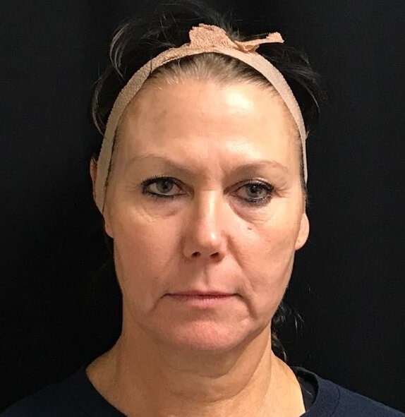 FACE/NECK BROW LIFT, LOWER LID Before