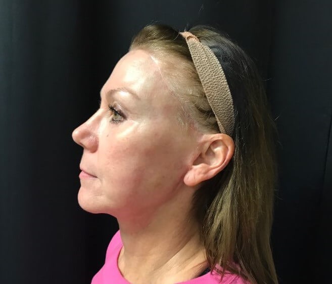 Left side view After