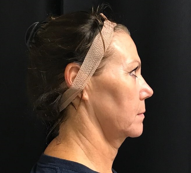 Right side view Before