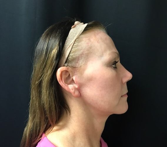 Right side view After