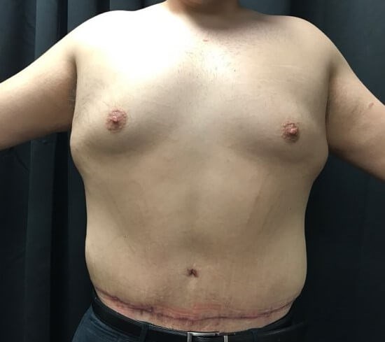 Circumferential Lipectomy After
