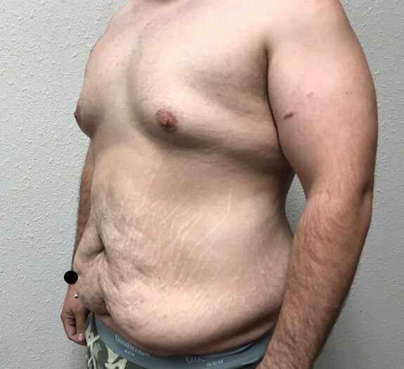 Left side view Before