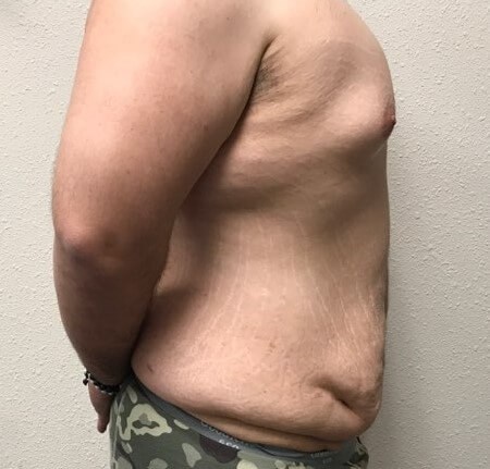 Right side view Before