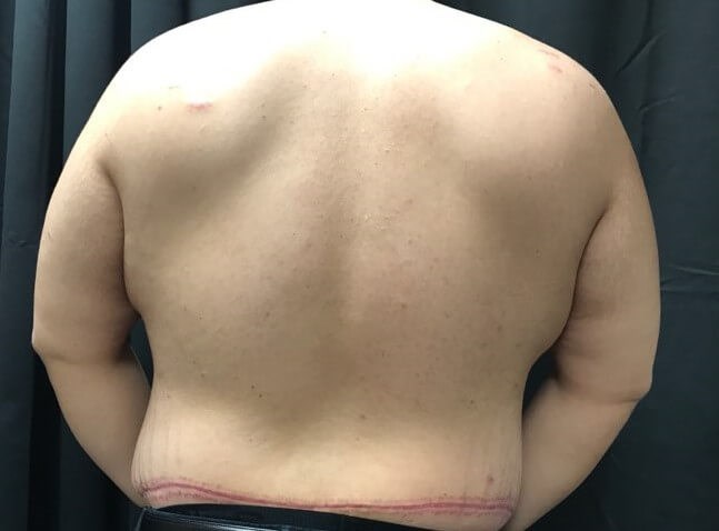 Back (post-op only) After