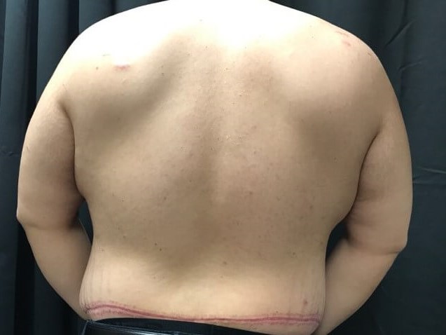 Back (post-op only) After
