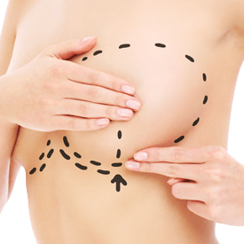 Breast Augmentation + Lift